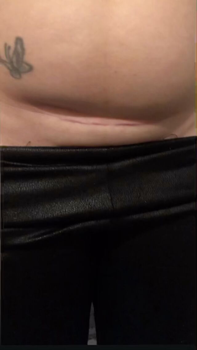 “Introducing LymphaTouch and Scar Therapy – your secret to post-C-section and abdominal surgery recovery! Experience faster healing, reduced swelling, and smoother, healthier-looking skin. Say goodbye to discomfort and hello to confidence! 

Book a FREE scar check or scar therapy initial appointment, link in bio #LymphaTouch #ScarTherapy #CSectionRecovery #AbdominalSurgeryRecovery #HealingJourney”
